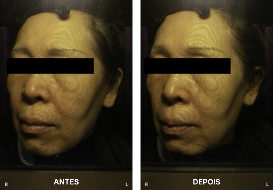 Resultados do tratamento na face